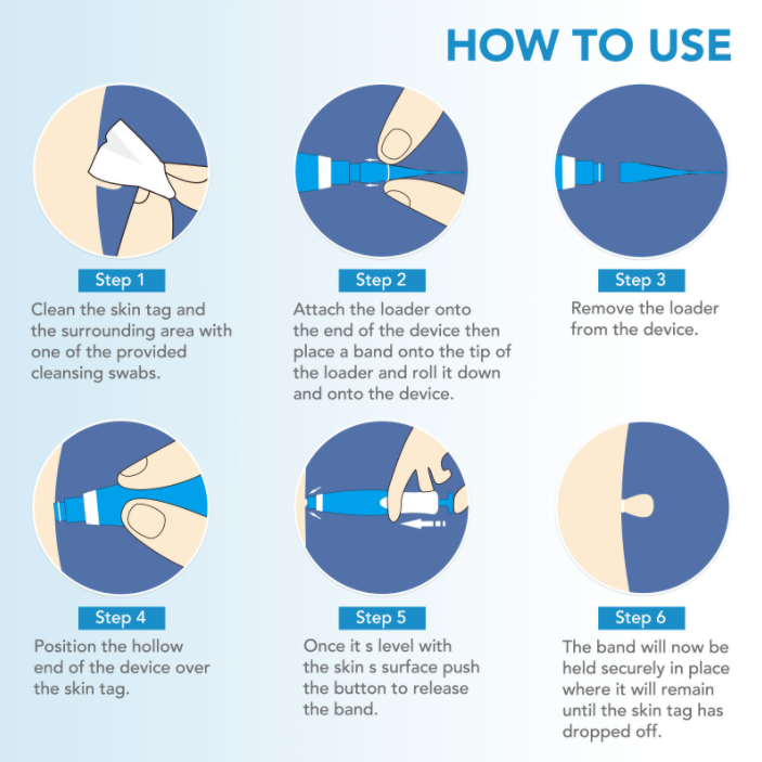 Skin Tag Removal Kit - Image 5